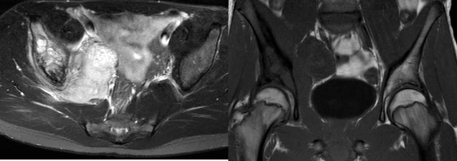 Figure 3 for case Ewing Sarcoma